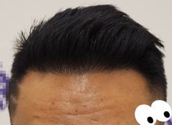 -大麦微针植发全国连锁