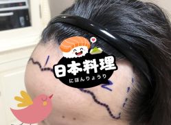 -大麦微针植发全国连锁