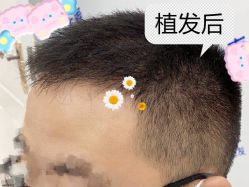 -大麦微针植发全国连锁