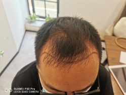 点击看大图 体验前-大麦微针植发丨全国连锁