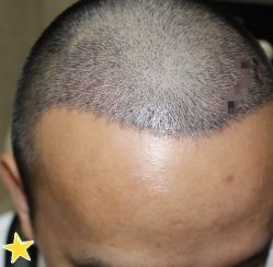 -大麦微针植发丨全国连锁