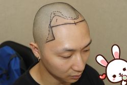 点击看大图 -大麦微针植发丨全国连锁