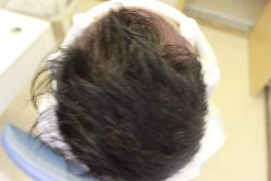 -大麦微针植发丨全国连锁