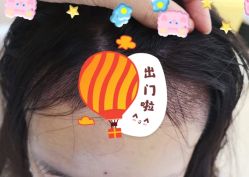 -大麦微针植发全国连锁