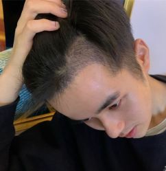 -碧莲盛·不剃发植发