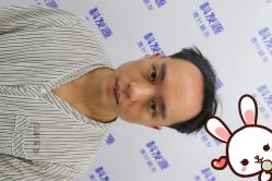 点击看大图 -大麦微针植发丨全国连锁