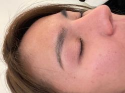 体验后-海涛医疗美容·面部抗衰·注射美鼻