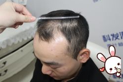 -大麦微针植发丨全国连锁