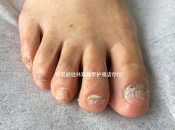 -德哥灰指甲脚气甲沟炎跖疣护理