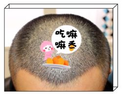 -大麦微针植发全国连锁