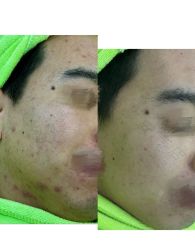 -苗医生0感祛痘连锁