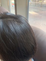 -碧莲盛·不剃发植发