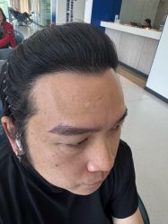 -大麦微针植发全国连锁