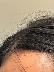 -碧莲盛·不剃发植发