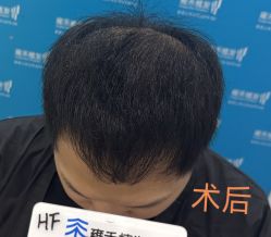 -雍禾植发