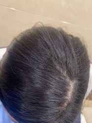 -碧莲盛·不剃发植发