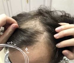 -大麦微针植发全国连锁