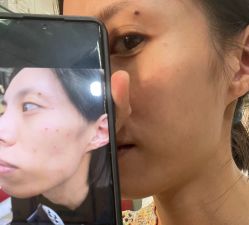 -北京美痣堂古方祛痣斑疣瘊