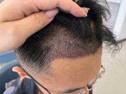 -大麦微针植发全国连锁