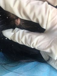 -美丽人生祛斑扁平疣汗管瘤中心