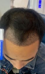 -大麦微针植发丨全国连锁