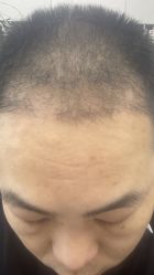体验后-大麦微针植发丨全国连锁
