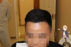 -大麦微针植发丨全国连锁