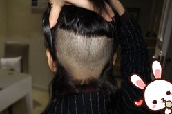 -大麦微针植发丨全国连锁