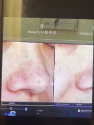 -苑苑vbeauty科技美容SPA