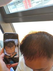 -碧莲盛·不剃发植发