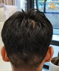 -大麦微针植发丨全国连锁