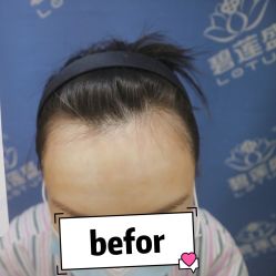 -碧莲盛·不剃发植发