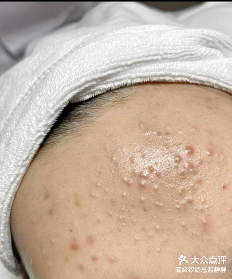 毛孔堵塞不及时清洁的样子