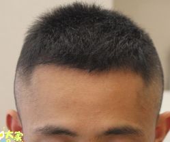 -大麦微针植发丨全国连锁