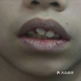 门牙外翻矫正案例