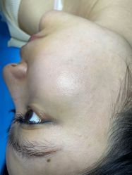 体验后-爱莎扁平疣·汗管瘤·斑痣中心