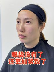 -广州健丽·去眼袋医疗美容机构