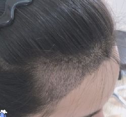 -大麦微针植发全国连锁