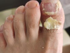 -世龙世家甲沟炎·灰指甲·嵌甲矫正·修脚(武侯区双楠店)