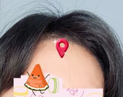 -大麦微针植发全国连锁