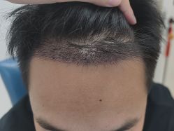 -大麦微针植发丨全国连锁