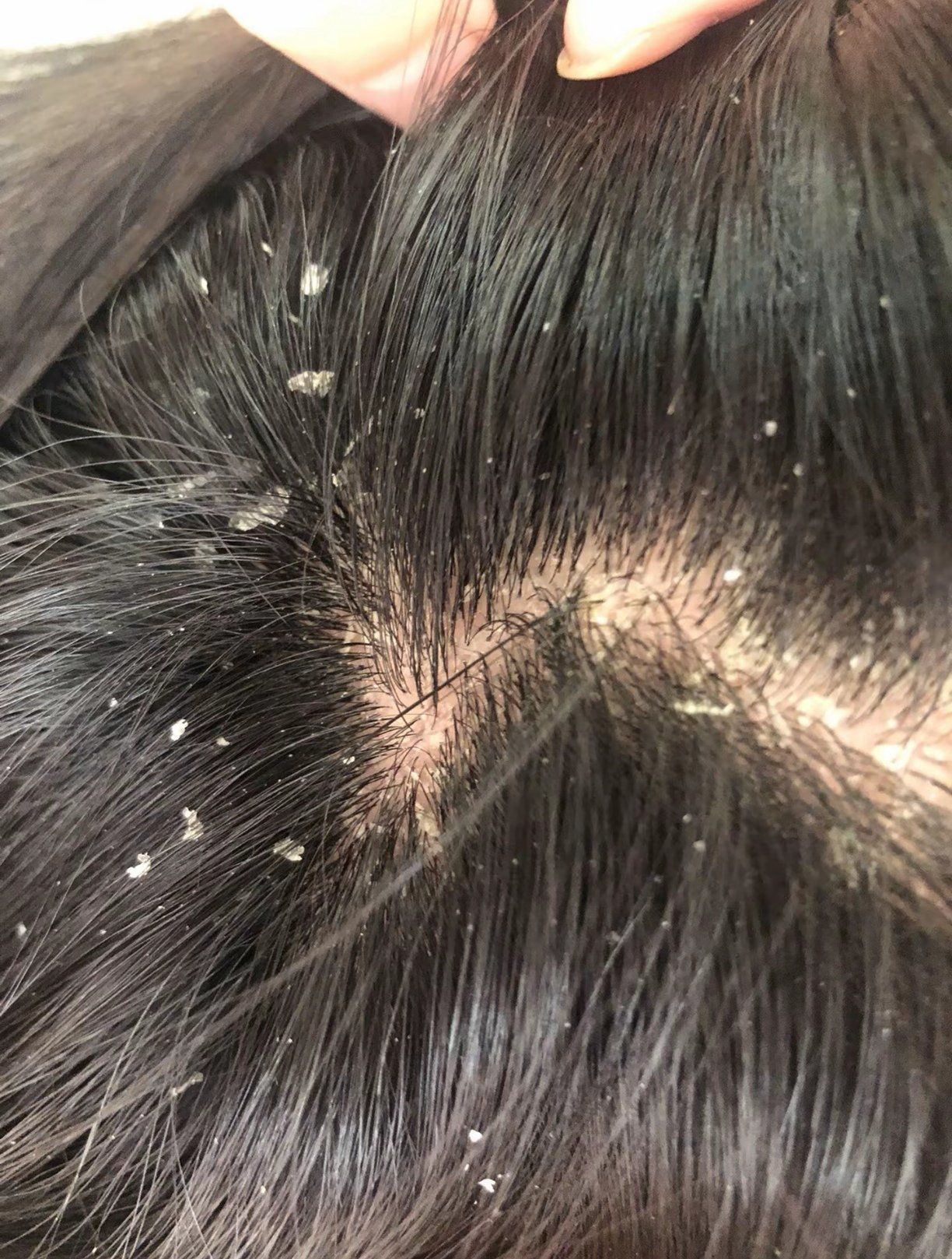头皮屑真是烦人!