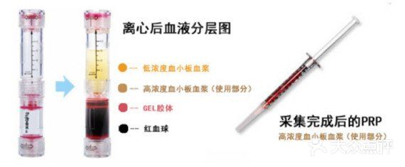 PRP在自体脂肪填充手术中到底有什么用？