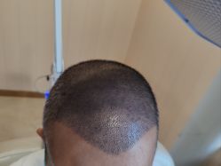 -碧莲盛·不剃发植发