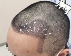 -大麦微针植发全国连锁