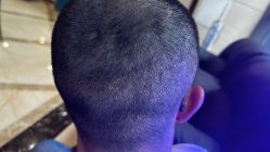 -碧莲盛·不剃发植发