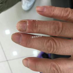 -德哥灰指甲脚气甲沟炎跖疣护理