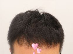-大麦微针植发全国连锁