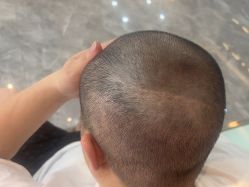 -碧莲盛·不剃发植发