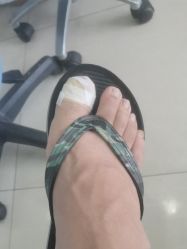 -德哥灰指甲脚气甲沟炎跖疣护理